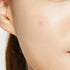 Acne Pimple Master Patch 24patches-Matakana Pharmacy